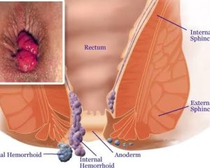 Haemorrhoids