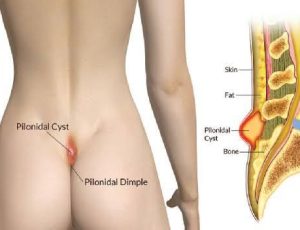 Pilonidal sinus_1